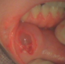 下唇粘液のう胞