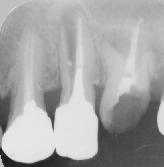 歯根破折のエックス線写真