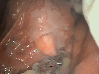 舌癌2