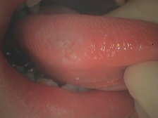 舌縁部　乳頭腫