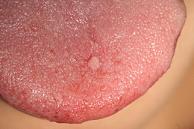 舌背部　乳頭腫