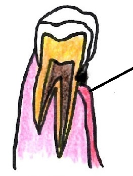 大人虫歯