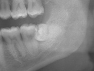 pre-coronectomy1