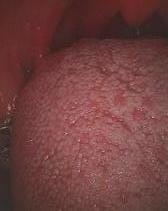 tongueleaf2 有郭乳頭