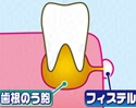 fistulaschema