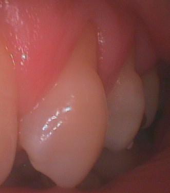 楔状欠損の小臼歯