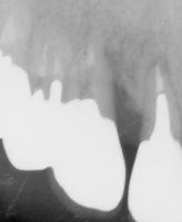 歯槽骨が吸収した犬歯