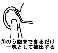 のう胞をできるだけ一塊として摘出する