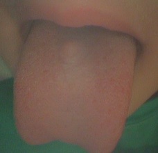 正中菱形舌炎2