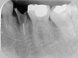 歯根破折症例1-1