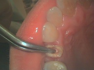 歯根破折症例2-2