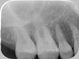 歯根破折症例3-1