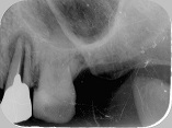 歯根破折症例5-1