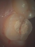 歯根破折症例3-3