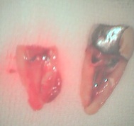 歯根破折症例5-2