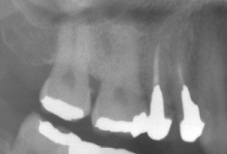 歯根破折症例2-1
