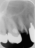 歯根破折症例4-1