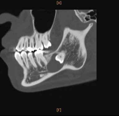 含歯性歯のう胞CT画像