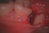 歯冠前方部の摘出