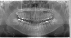 智歯抜歯症例　パノラマ
