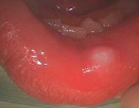 下唇の粘液のう胞