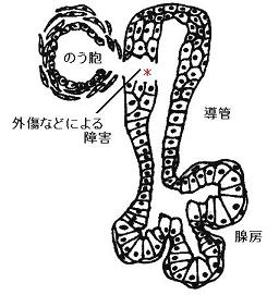 導管が傷ついて唾液が溢出し始める