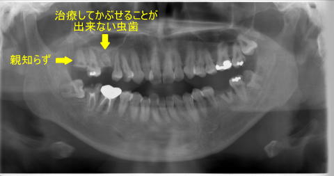 移植前のパノラマエックス線写真