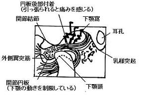 顎関節模式図　関節円板前方転位