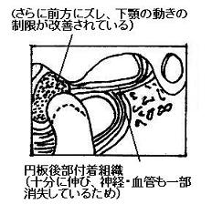 顎関節模式図　関節円板前方転位