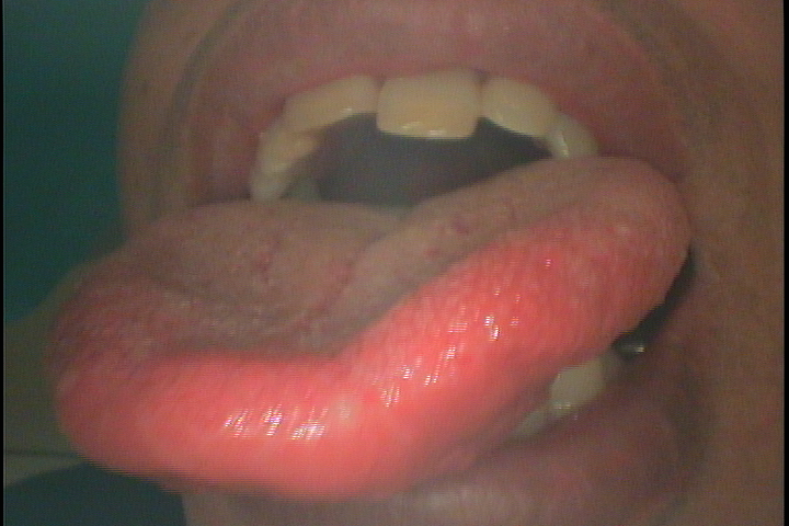 口腔粘膜炎