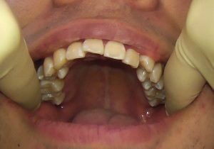臼歯腺