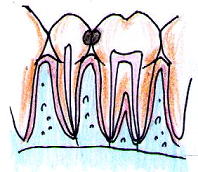 隣接面（歯と歯の間）で虫歯ができている