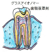 暫間的歯髄覆髄法2