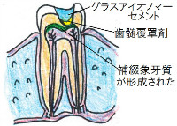 暫間的歯髄覆髄法3