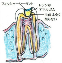 虫歯を削らず、穴を詰める治療法