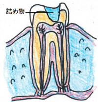 暫間的歯髄覆髄法4