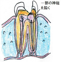 歯髄の一部を切り取る、部分断髄