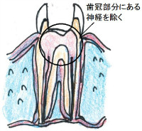 歯の中の神経を全て抜くのではなく、冠部歯髄のみを取り除く