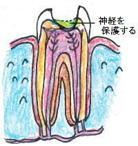 神経を抜かずに保護して穴を塞ぐ直接覆髄