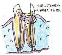 歯の中の神経を全て抜くのではなく、虫歯に近い部分の歯髄の一部を取り除く