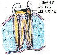 神経近くまでの深い虫歯