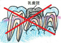 虫歯をすべて取り除き乳歯冠を被せる