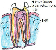 神経の近くまで達している虫歯