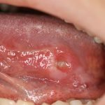 舌ガン