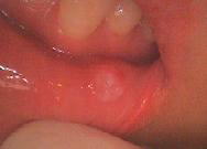 下唇にできた粘液のう胞