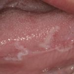舌ガン5
