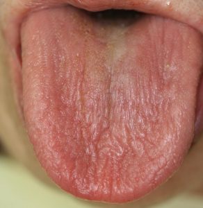シェーグレン症候群舌