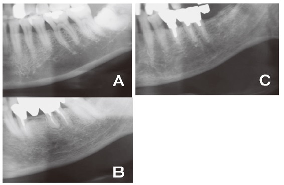 パノラマX線写真による骨粗鬆症スクリーニング法 : Teeth Tell Ta… Amazon.co.jp: パノラマX線写真による骨粗鬆症スクリーニング法