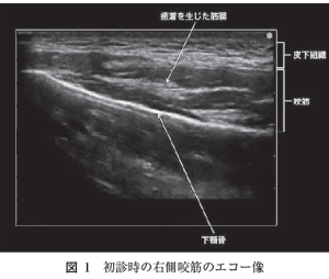 エコーガイド下筋膜リリース注射