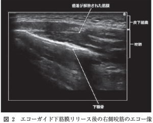 エコーガイド下筋膜リリース注射